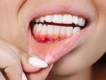 Overview of Common Gum Disease Symptoms and Treatment Methods